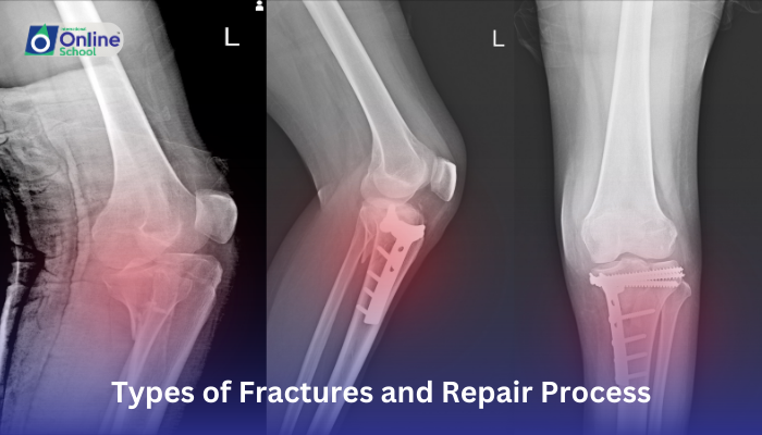 Lesson 07: Types of Fractures and Repair Process